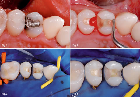 filling between teeth